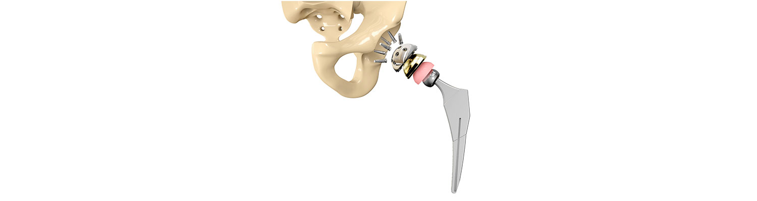 Federal Judge May Include Smith & Nephew Hip Replacement Lawsuits with Hip Resurfacing MDL