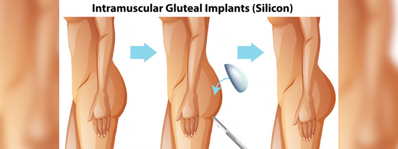 Profemur Hip Implant Cases Consolidated In Arkansas