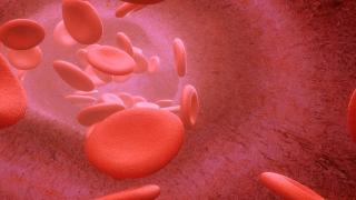 Dallas Federal Jury Finds Bard's IVC Blood Clot Filter Defective