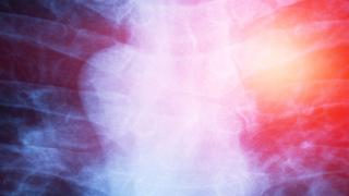 Louisiana Resident Secures $8.2M Verdict In Mesothelioma Lawsuit