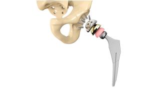 Zimmer Biomet Asks To Toss $3.55M Hip Implant Verdict